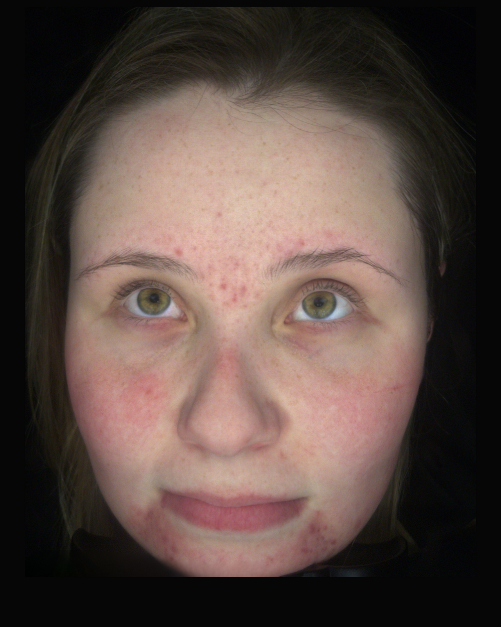 Before treatment