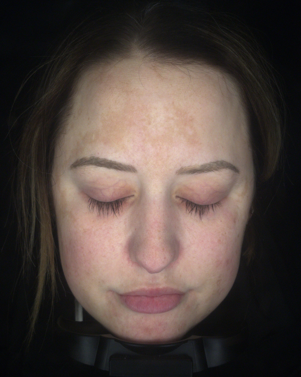Before treatment