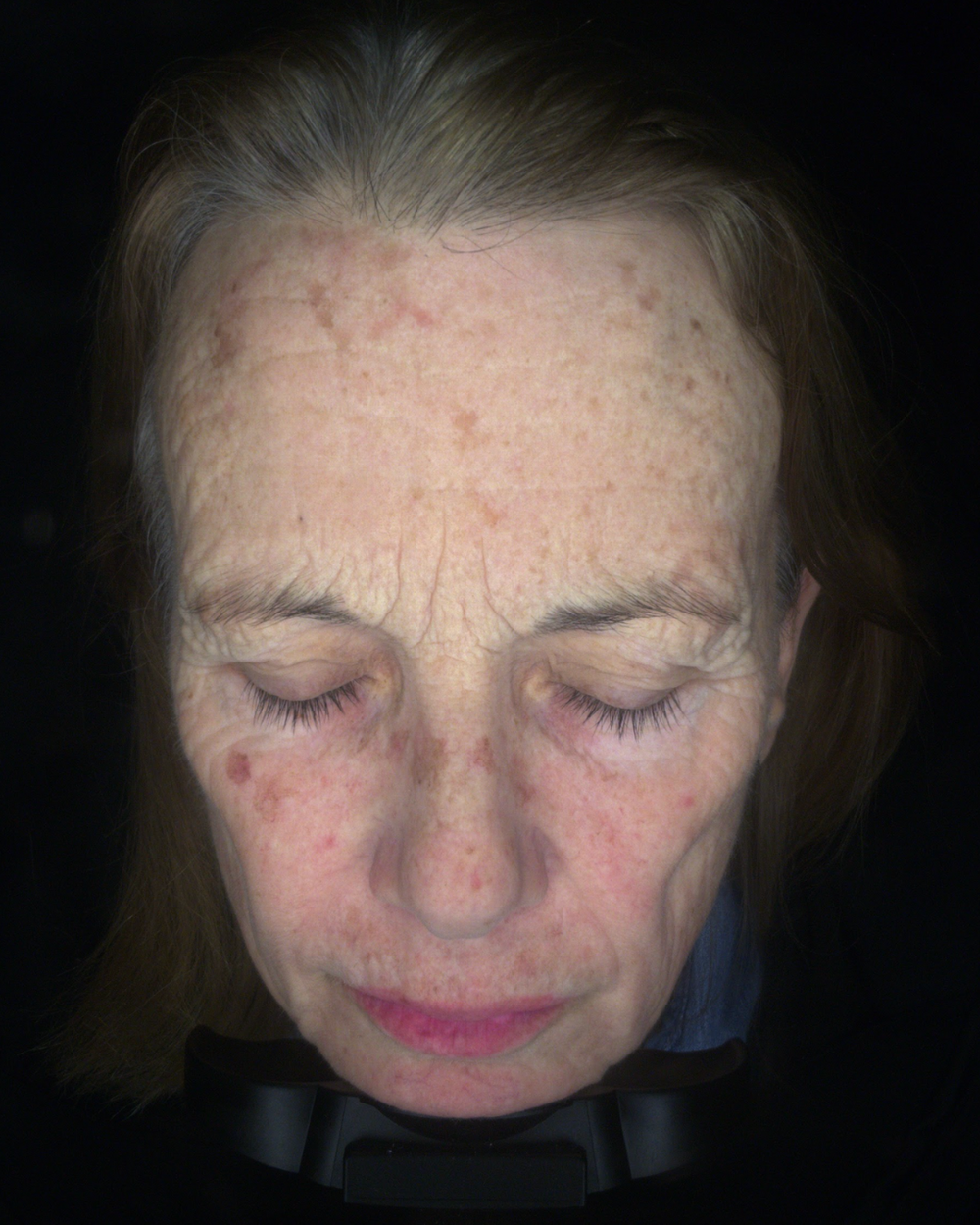 Before treatment