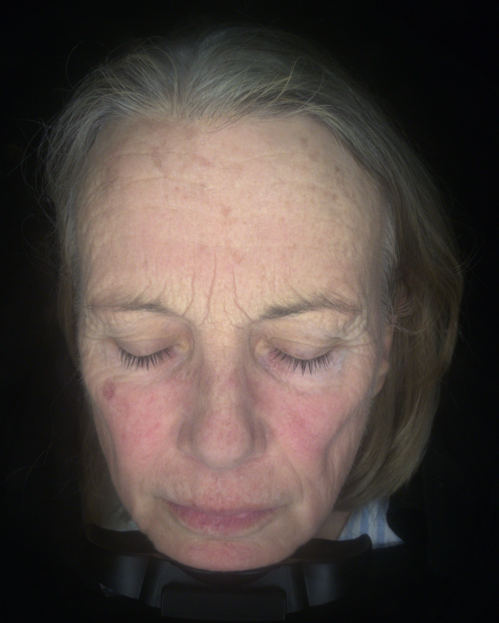 After treatment